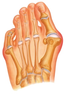 Bunion Treatment in UT  Bunion Foot Pain Treatment in Utah