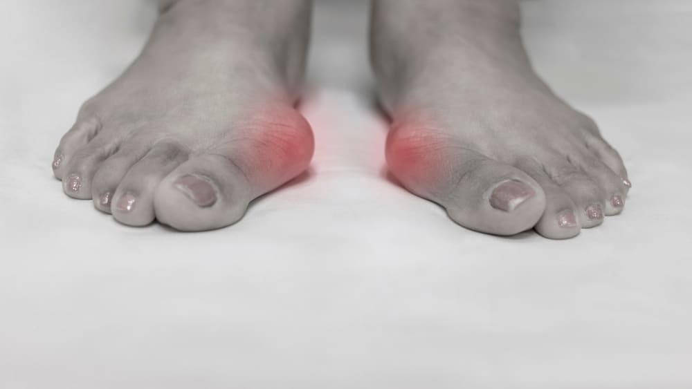 Causes of Supination and Treatment - High Arched Foot