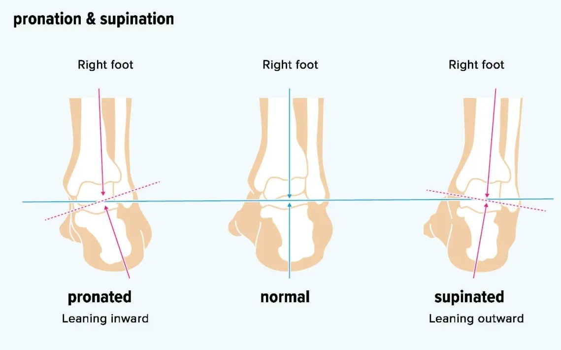 Taking a Step Inward: A ComprehensiveGuide to Excessive Pronation ...