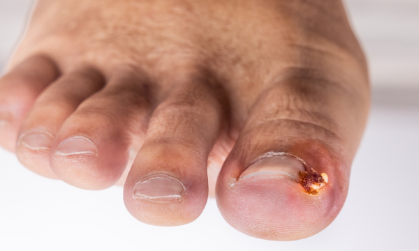 Ingrown Toenail Treatment at Utah County Precision Foot and Ankle